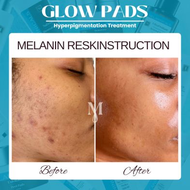 From Drama to Glow: The Real Tea on Dark Spots & Melanin-Rich Skin